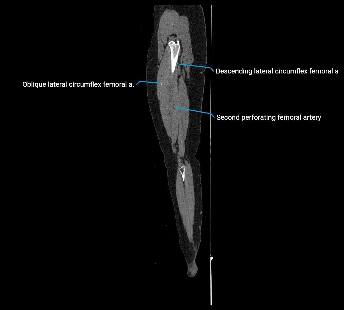 CTA lower limb sagittal cross sectional anatomy labelled image _61 (3).webp